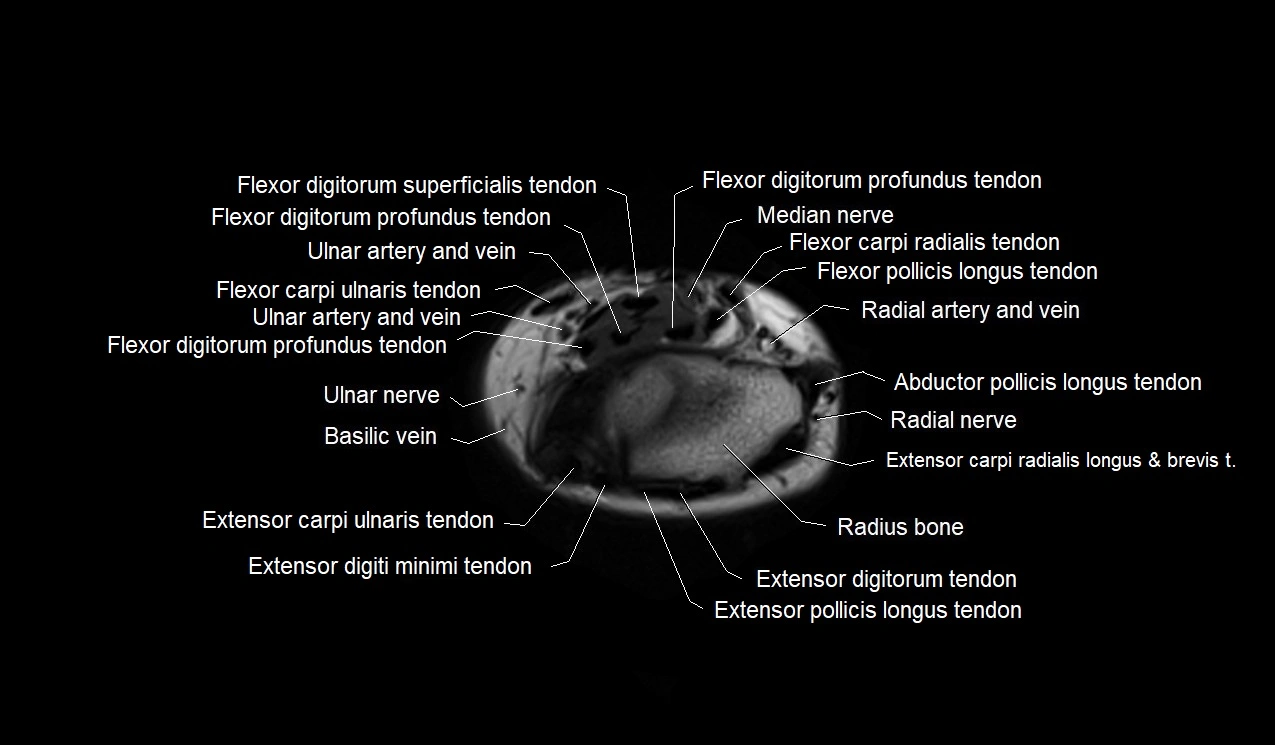 MRI 3T forearm axial cross sectional anatomy image 45.webp